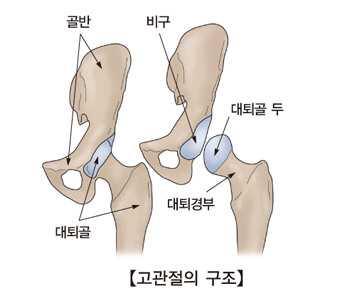 고관절 골절