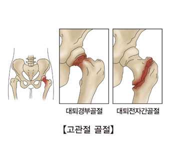 고관절 골절