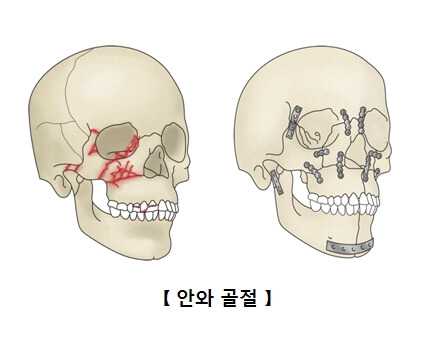 안와골절 방치