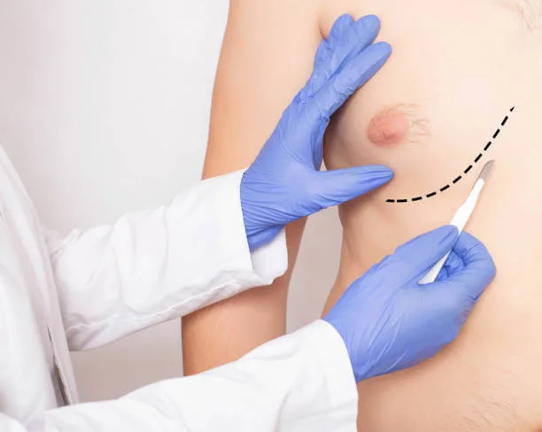 여유증 수술 비용과 보험 정보: 부담 없이 치료 받는 법 2 여유증 수술